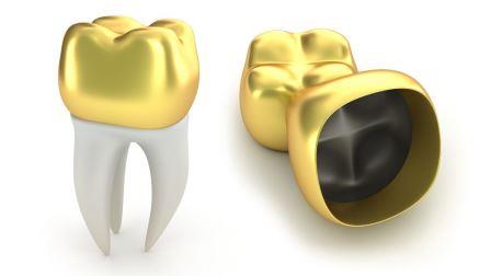 Tooth crown cost with insurance Affordable Luxury 24